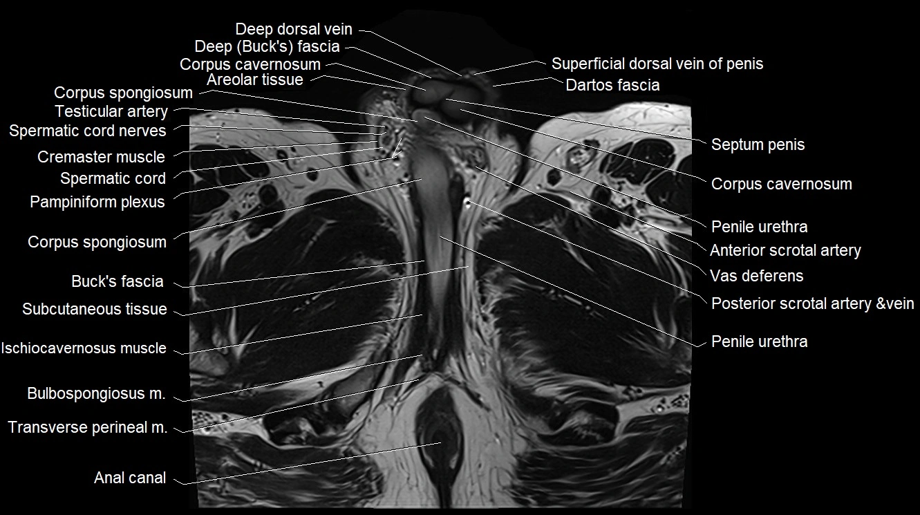 MRI 3T scrotum and penis axial cross sectional anatomy image 21.webp
